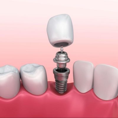 RĂNG SỨ TRÊN IMPLANT
